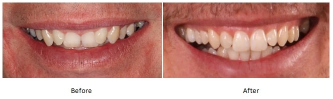 before and aftert Invisalign treatment Boulder and Denver, CO