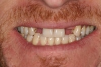 Dental Implant Benefits in Denver, CO