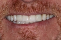 Dental Implant Benefits in Boulder, CO