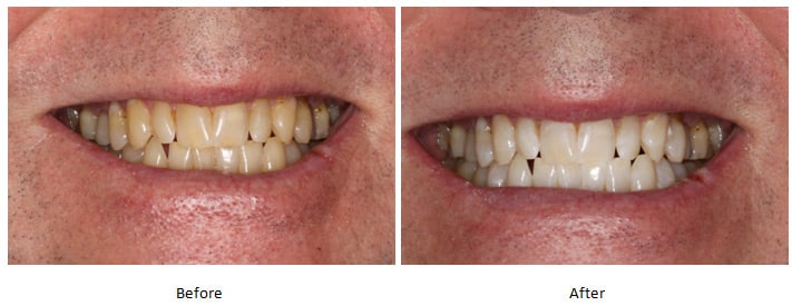 teeth before and after zoom