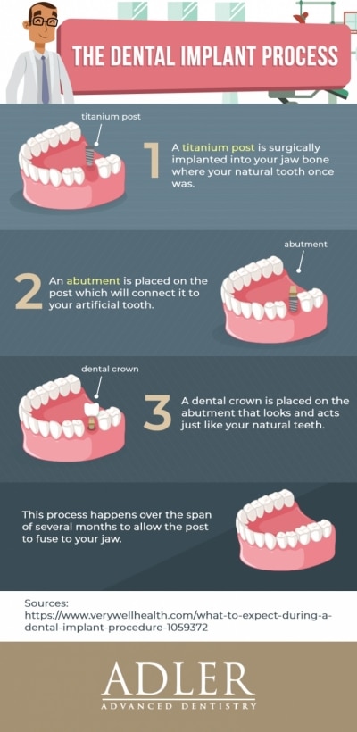 Dental Implants in Denver, CO