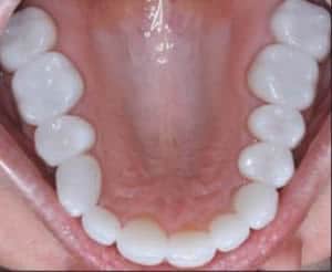 after restorative dentistry services in Boulder, CO