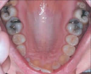 before restorative dentistry services in Boulder, CO