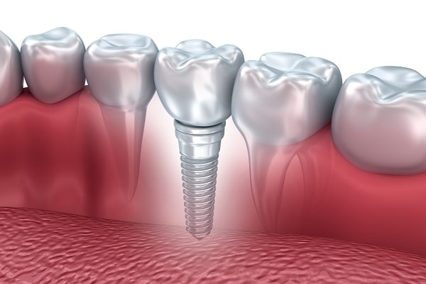 dental implants with crown 0