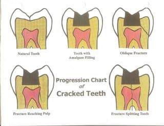 fractured tooth01