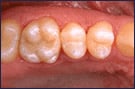 After White Dental Fillings in Boulder, CO