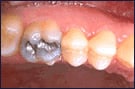 Before White Dental Fillings in Boulder, CO
