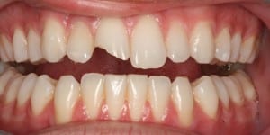 Boulder cosmetic dentistry case with chipped tooth