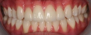 Boulder cosmetic dentistry case after image