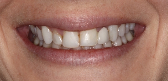 Boulder cosmetic dentistry Elizabeth before image