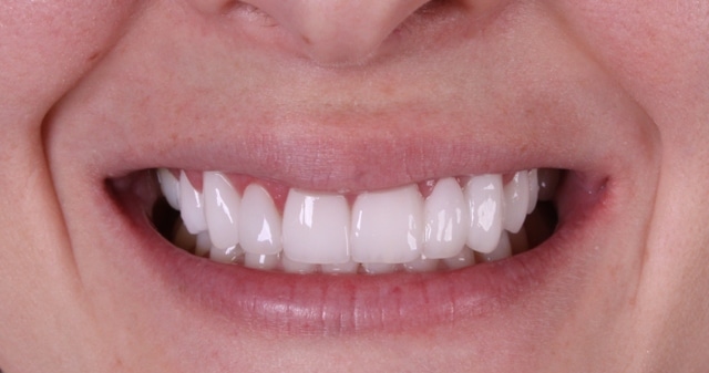 Boulder cosmetic dentistry Elizabeth after image