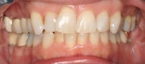 Boulder cosmetic dentistry Sarah before image