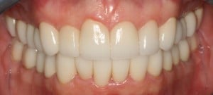 Boulder cosmetic dentistry Sarah after image