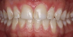 Robert's before teeth by boulder colorado cosmetic dentist Michael Adler