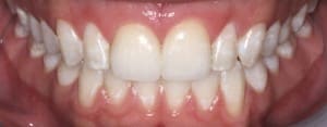 Robert's after teeth by boulder colorado cosmetic dentist Michael Adler