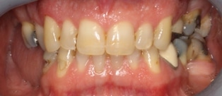 patient teeth before by Boulder Colorado cosmetic neuromuscular dentist Michael Adler