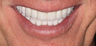 patient teeth after by Boulder Colorado cosmetic neuromuscular dentist Michael Adler