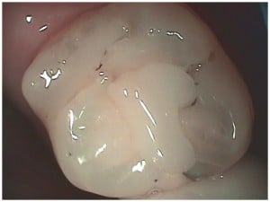 tooth 2 before image showing fracturing by Boulder dentist Michael Adler