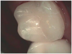 restored tooth using CEREC crown by Boulder dentist Michael Adler