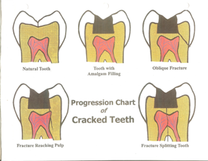 fractured-tooth-illustration-sm