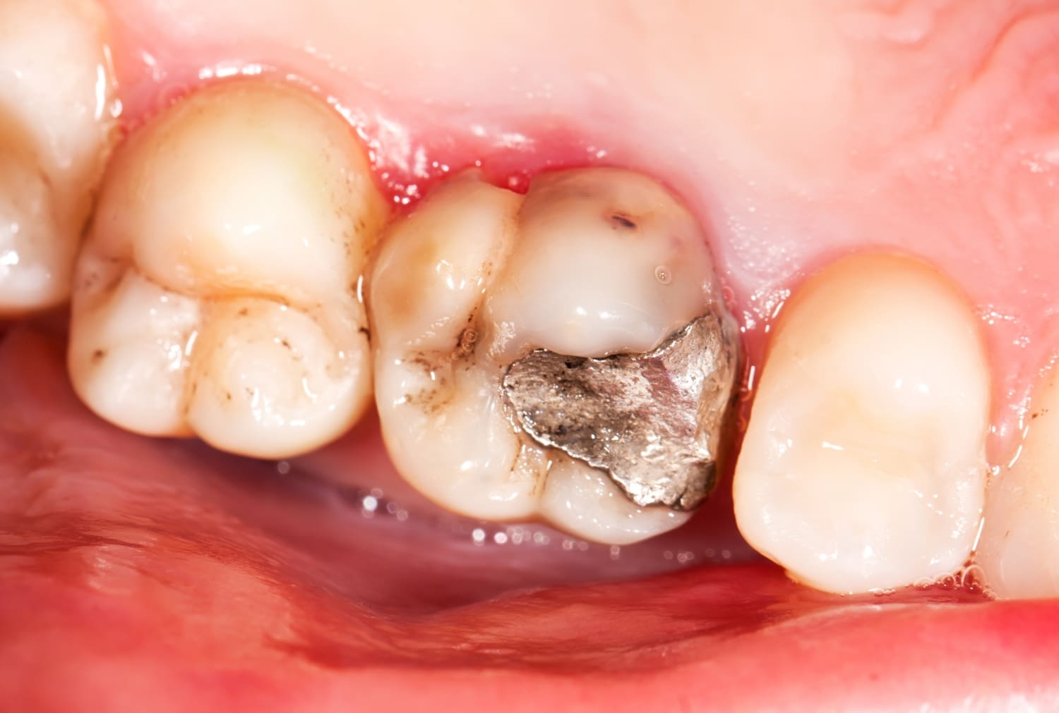 Decay under dental crown