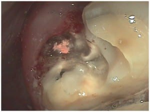 Molar Tooth after Dental Crown is Removed