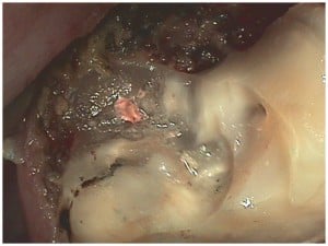 Molar tooth after laser removed excess tissue and decay