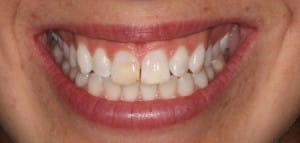 kelsy teeth before image by boulder cosmetic dentist Michael Adler