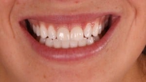 kelsy teeth after image by boulder cosmetic dentist Michael Adler