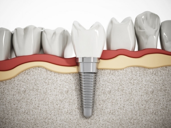 dental implant procedure boulder colorado dentist