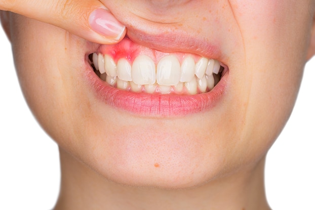 Boulder woman shows signs of gingivitis, gum disease.