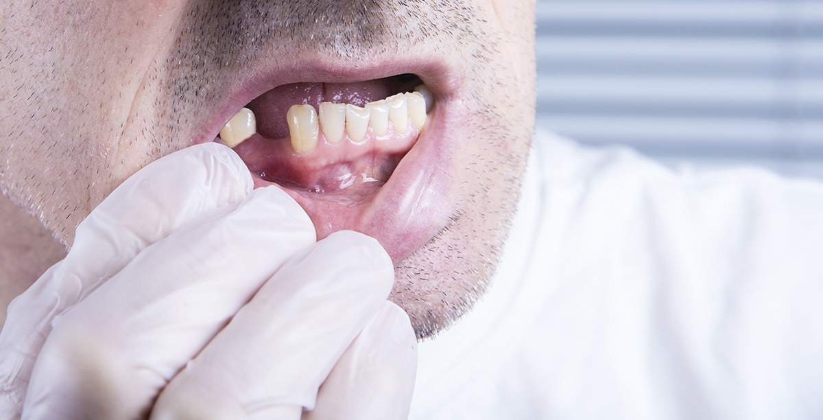 Boulder man loses tooth and seeks dental implant from Dr. Adler