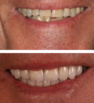 After Image: Full Mouth Reconstruction and Neuromuscular Treatment - front