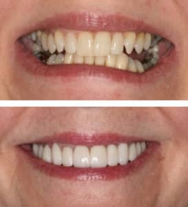 After Image: Full Mouth Reconstruction and Neuromuscular Treatment