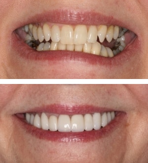 After Image: Full Mouth Reconstruction and Neuromuscular Treatment - front