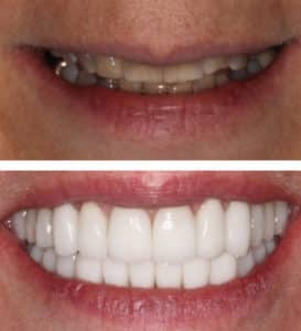 Full Mouth Reconstruction and Neuromuscular Treatment