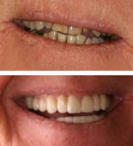 Full Mouth Reconstruction and Neuromuscular Treatment