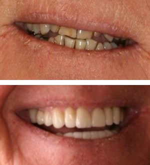 After Image: Full Mouth Reconstruction and Neuromuscular Treatment - front