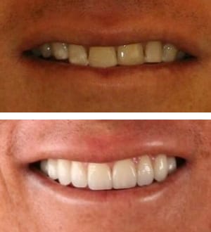 After Image: Full Mouth Reconstruction and Neuromuscular Treatment - front