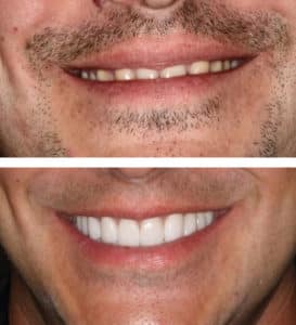 After Image: Full Mouth Reconstruction and Neuromuscular Treatment