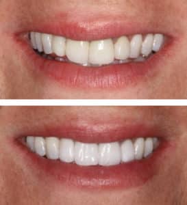 Invisalign and Porcelain Veneers