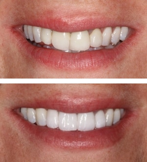 After Image: Invisalign and Porcelain Veneers - front
