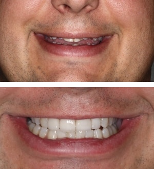 After Image: Invisalign and Porcelain Veneers - front
