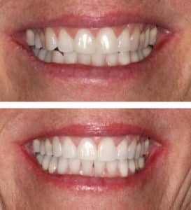 After Image: Invisalign and Zoom Laser Whitening