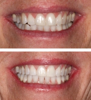 After Image: Invisalign and Zoom Laser Whitening - front