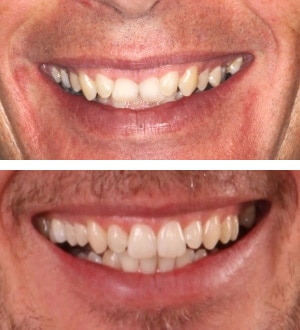 After Image: Invisalign - front