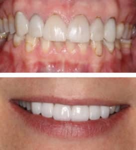 After Image: Porcelain Veneers