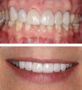 Porcelain Veneers