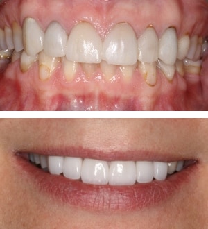 After Image: Porcelain Veneers - front