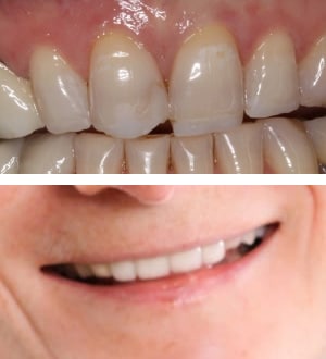 After Image: Porcelain Veneers and Bridges - front